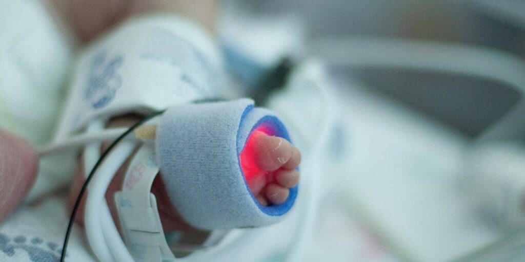 Infant Frenectomy