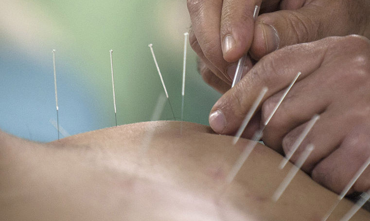 Woodbury Acupuncturist